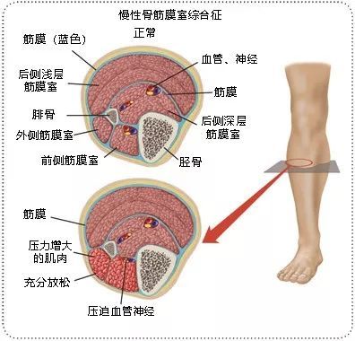 将近一半跑者都会遭遇的伤病,你中枪了吗?