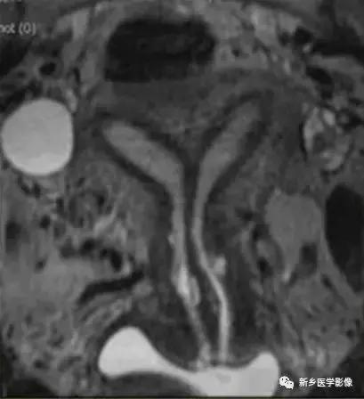 子宫发育异常，应想到的6大类常见畸形