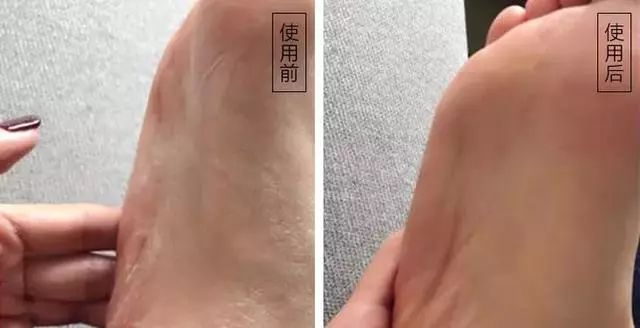 夏天了手脚干裂还有老茧,手脚干裂脱皮老茧用什么药膏