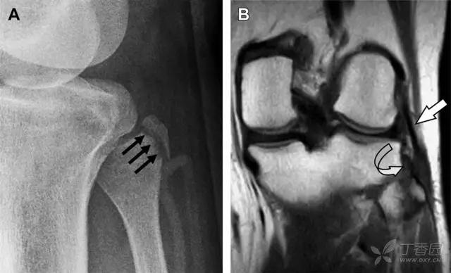 值夜班急救措施,放射科容易漏诊的骨折