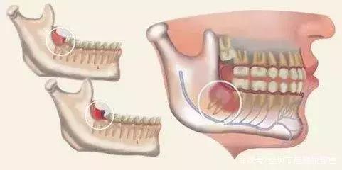 智齿冠周炎引起的下颌骨疼痛,智齿冠周炎张口受限伴吞咽疼痛
