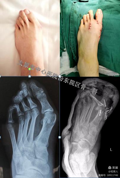 太原中心医院汾东院区骨科,太原汾东中心医院骨科拇外翻大夫