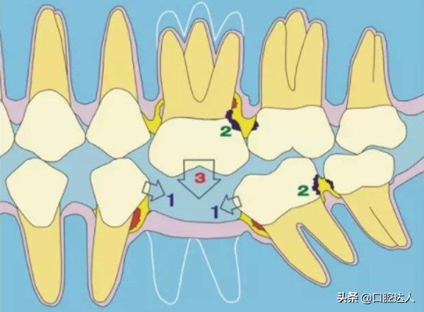 一直犹豫种不种牙，有什么建议吗？