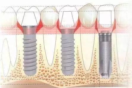 种植牙的一般使用寿命是多久,种植牙使用寿命多长需要更换吗