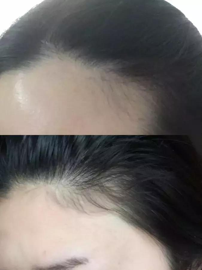 头发毛躁并且脱发推荐洗发水,用什么洗发水改善头皮脱发