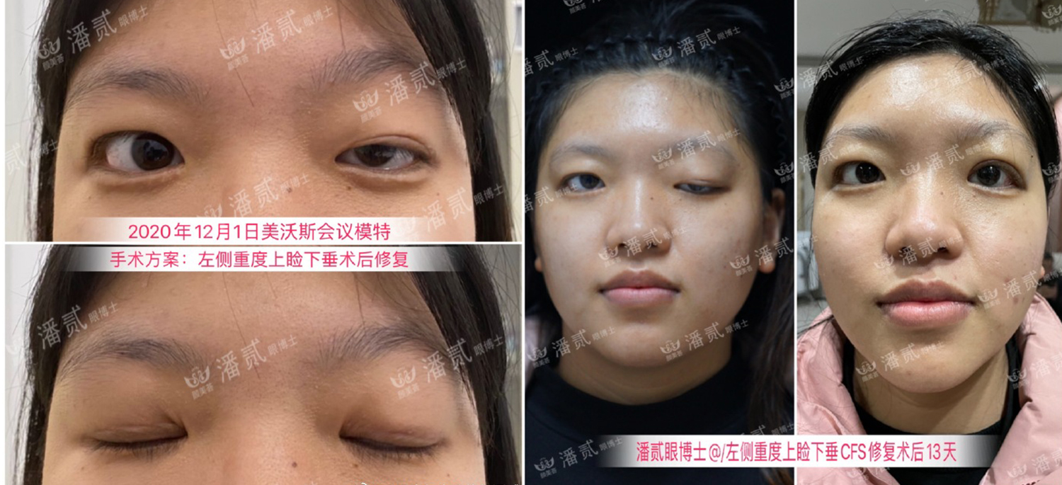 双眼皮离眉毛太近还能修复好吗,割双眼皮眉毛下面肿会消肿吗