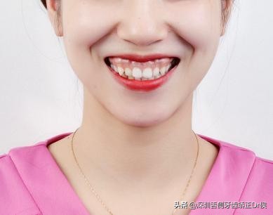 露龈笑原因,露龈笑矫正