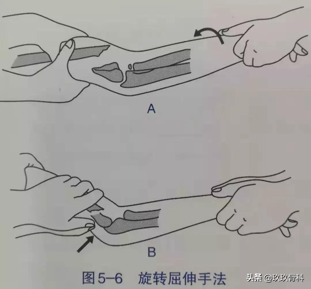骨折手法整复术多少钱,骨折恢复手法视频教程