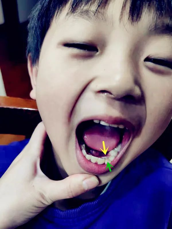 为什么乳牙好换牙就不好了,为什么现在的孩子换的门牙特别大