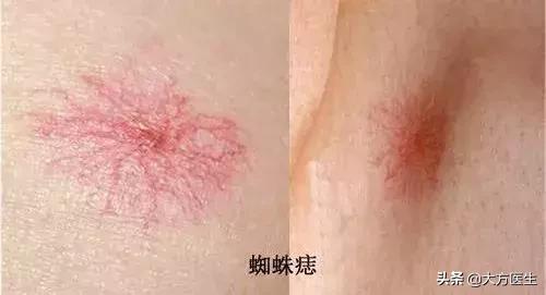 肝病引起的蜘蛛痣代表着什么,警惕这种痣可能是肝硬化