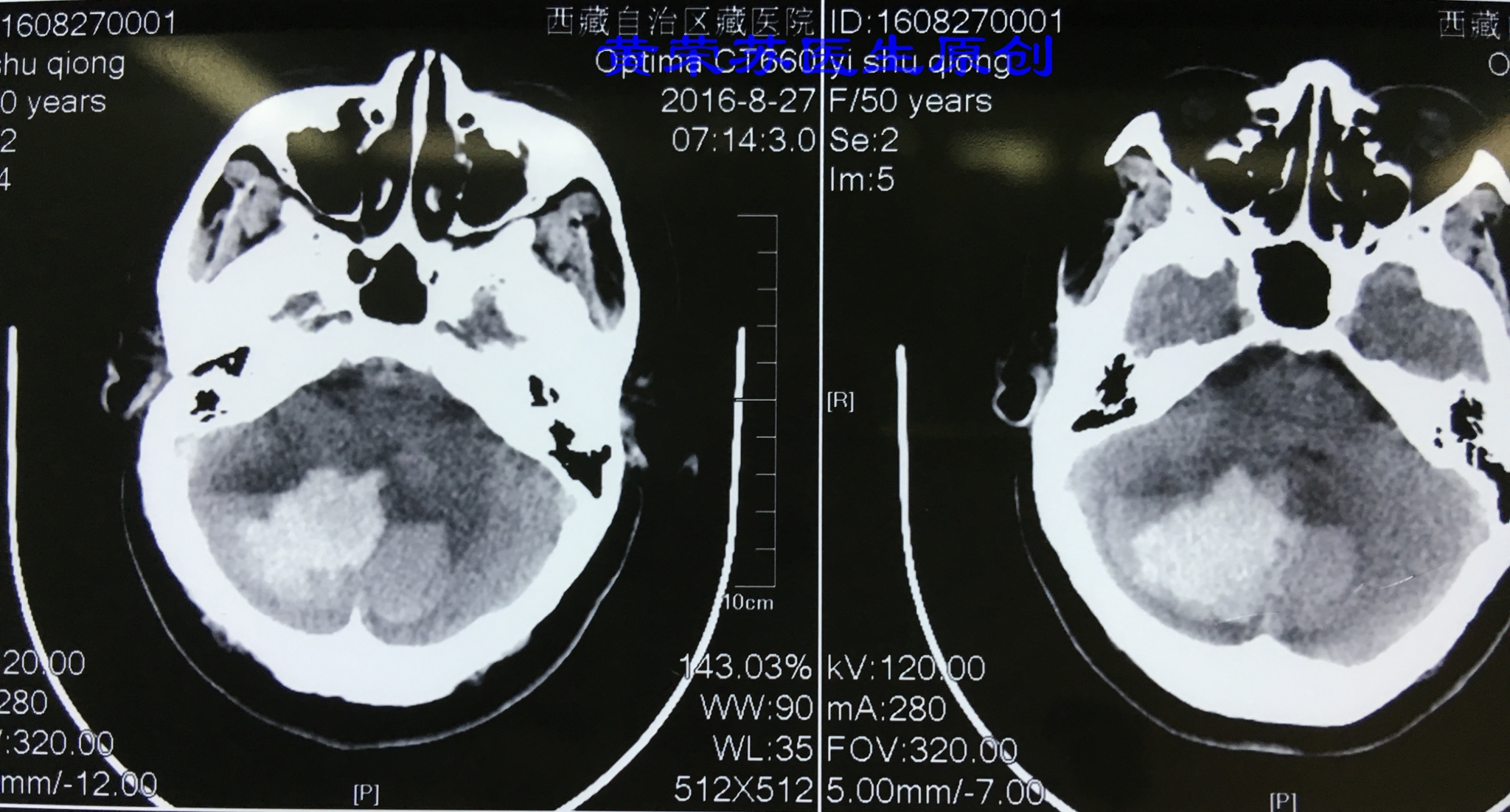 脑出血症状科普动画视频,脑出血的出血部位脑细胞会坏死吗