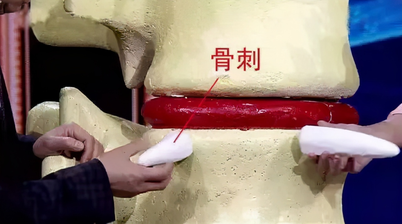 骨刺没有症状需要消除吗,骨刺用什么方法能消掉