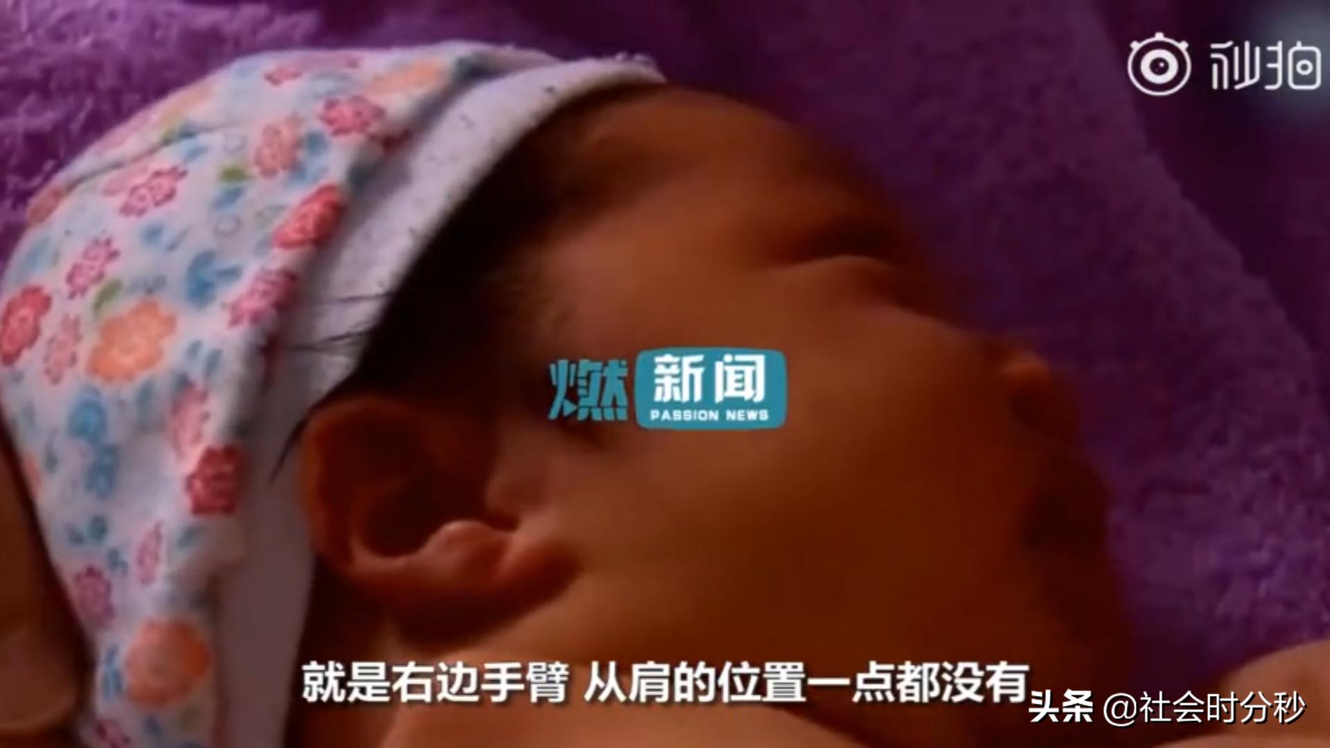 产检中发现胎儿手指缺失,孕检没查出来孩子生下来手指缺陷