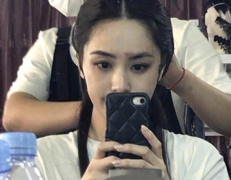 阿娇伤后首露面图片,阿娇晒出额头受伤照片