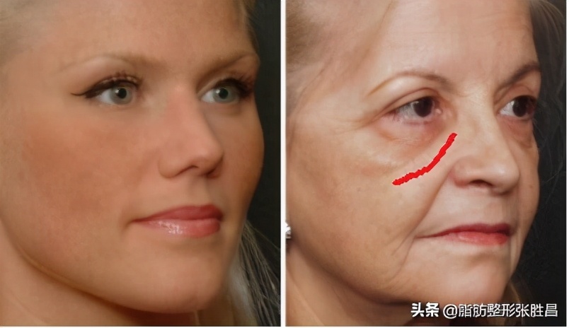 印第安皱纹,印第安纹去皱纹