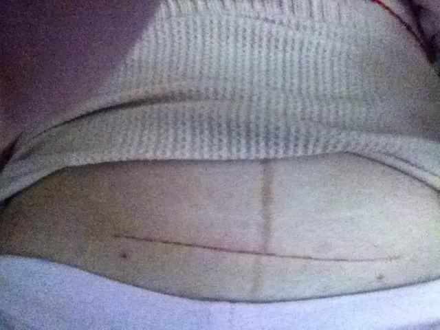 剖腹产产妇疤痕怎样修复,剖腹产疤痕对产妇有影响吗