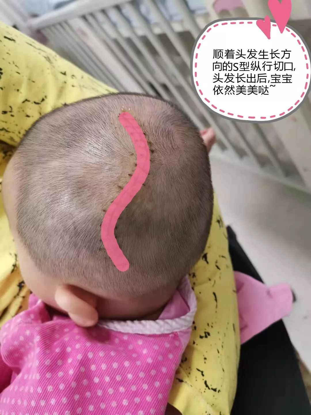 小孩重度颅脑损伤康复案例,儿童颅骨损伤修补手术