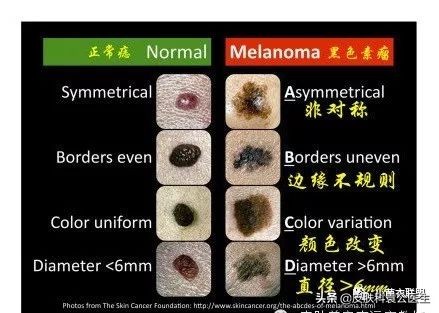 痣边缘模糊图片,痣长多大会变成黑色素瘤