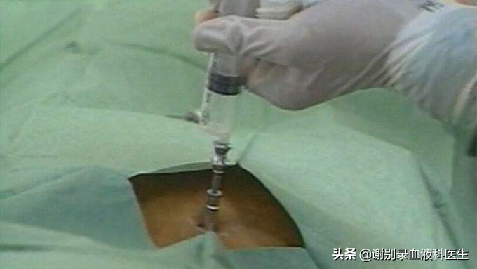 做骨穿对身体有后遗症吗,小孩做骨穿的后遗症