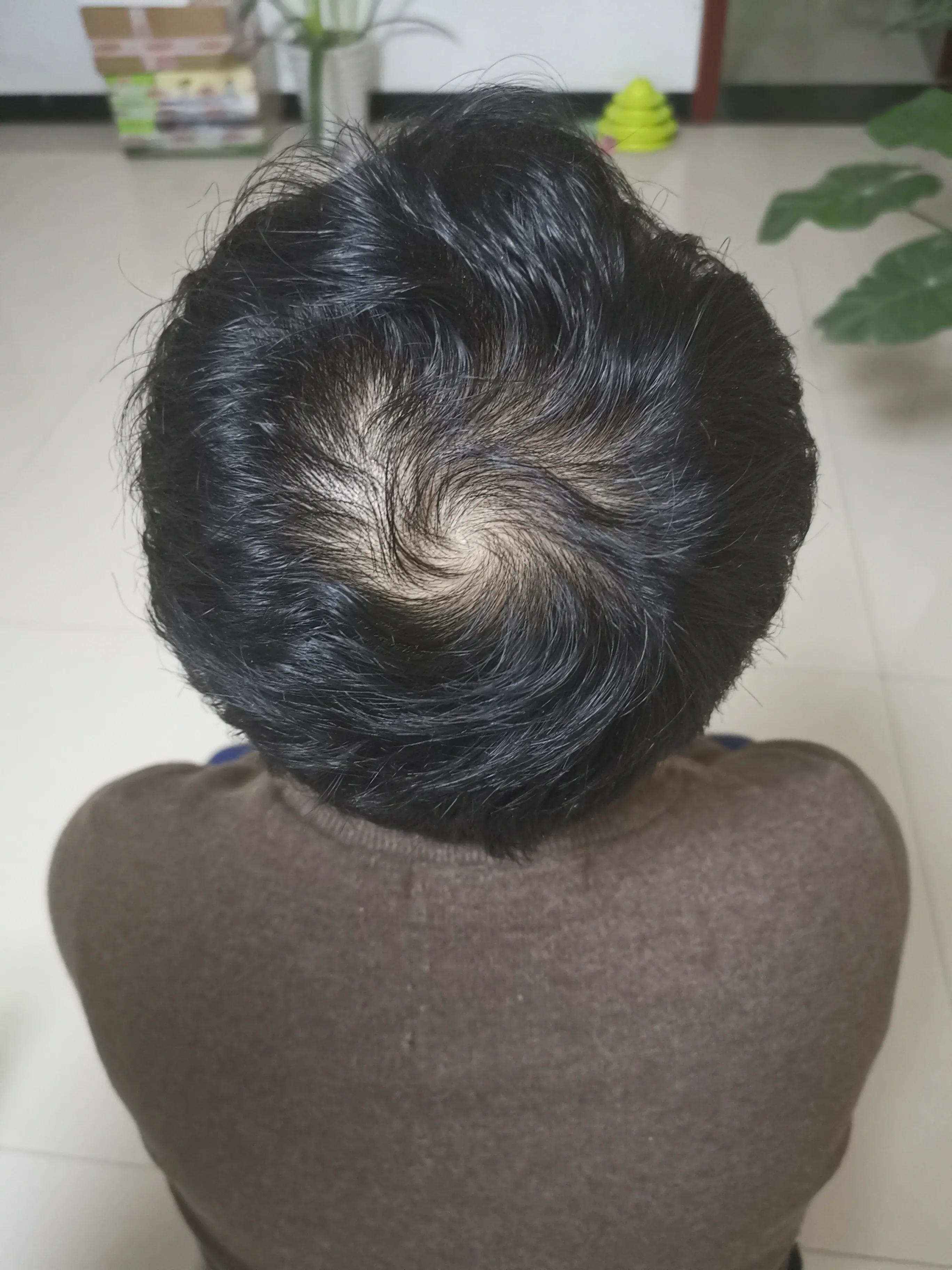 华山医院植发费用2020,2020植发视频