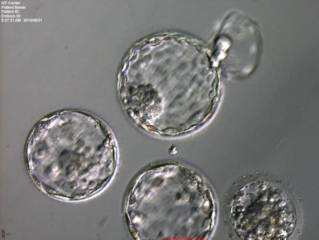 做试管还要看“颜值”？专家：“颜值”达到这个标准才能移植！