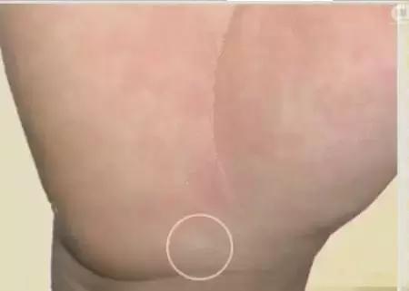 手的健康识别,看手识病疾病自测