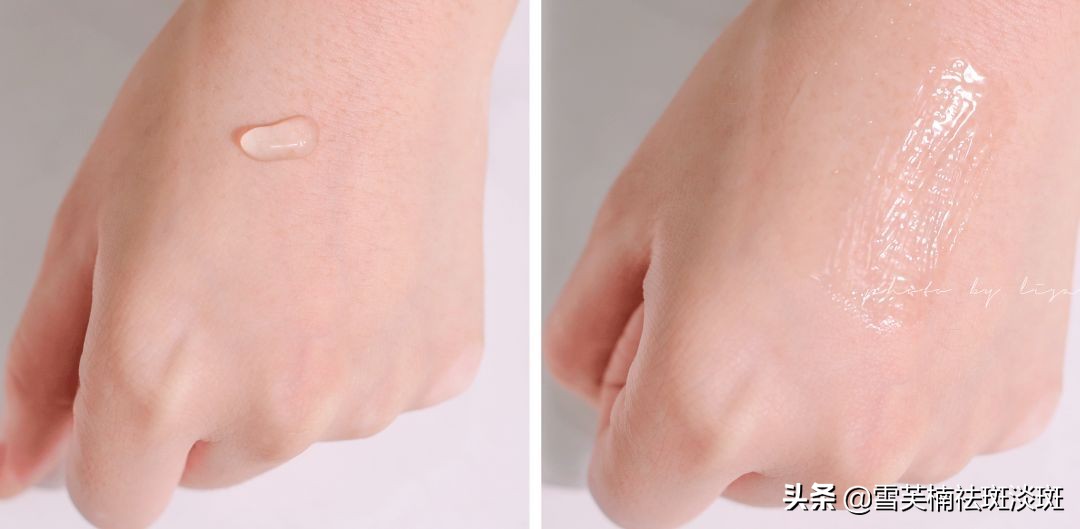 雀斑是遗传性还是后天性？普及一下雀斑更多可能的形成原因