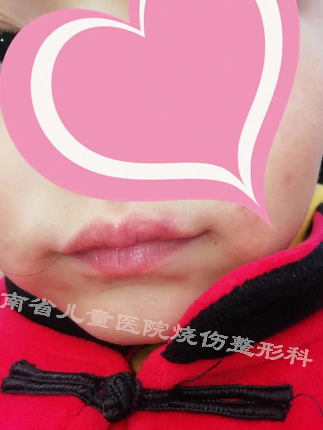 嘴唇上有红色的小血点出血止不住,嘴唇上小红点流血不止