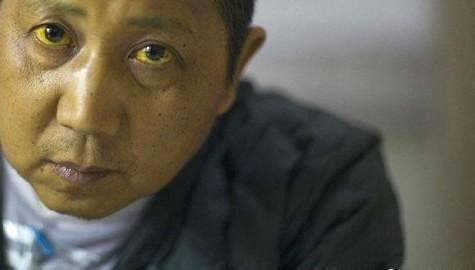 体检前一晚吃橘子胆红素升高,体检报告总胆红素偏高有什么影响