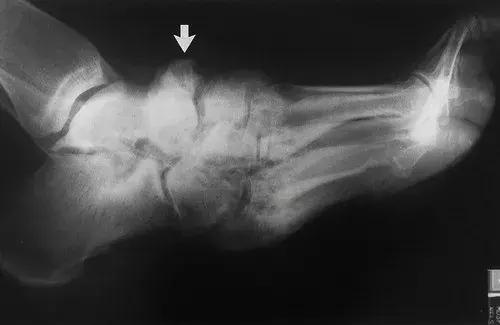 神经性骨关节病,神经性关节炎症状图片