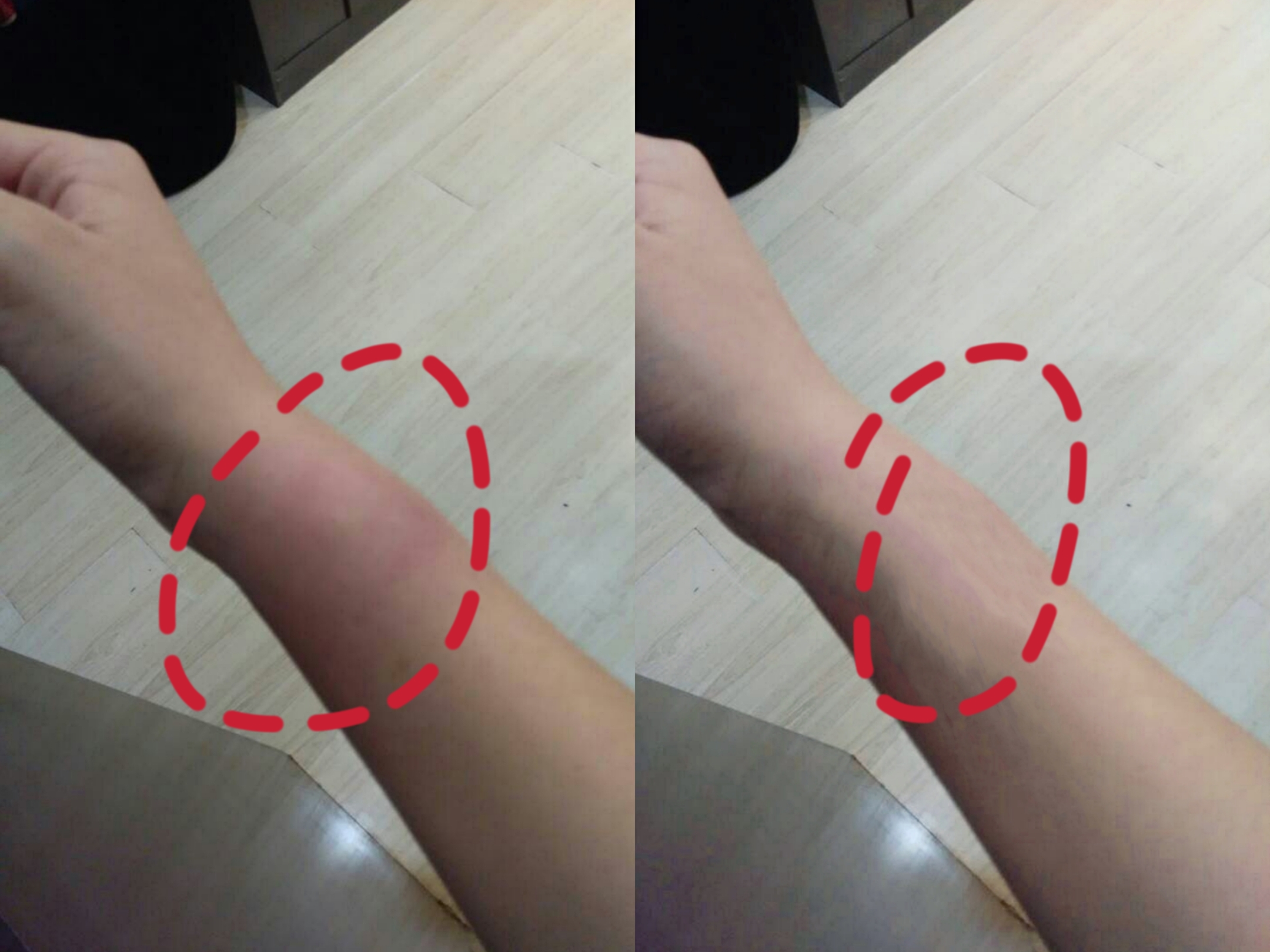 紫外线晒皮肤发红怎么办,紫外线晒得又红又痒怎么办