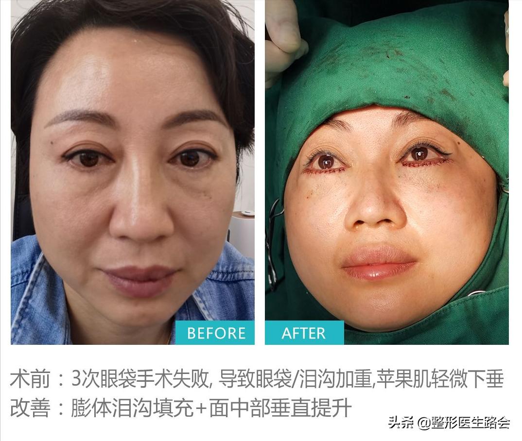 太阳穴凹陷颧骨高适合留中分吗,太阳穴凹颧骨高用什么哑光高光好