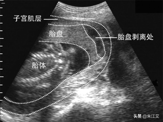 子宫异常出血和功能性出血的区别,育龄妇女子宫异常出血一直出血