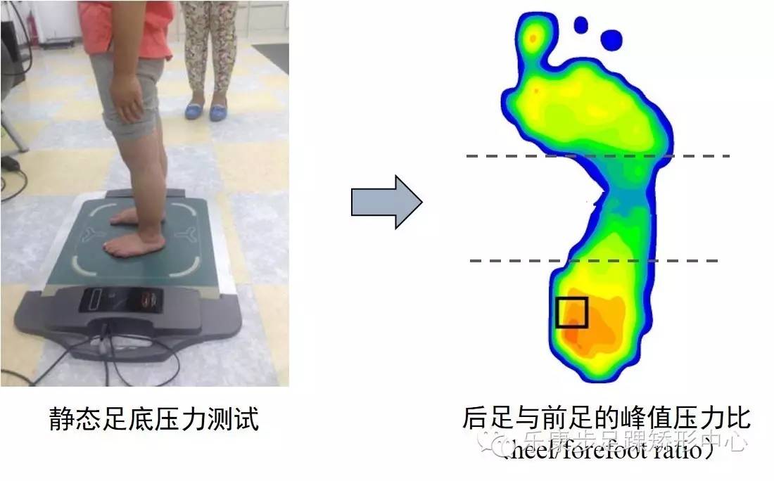 定制矫正鞋鞋垫,定做矫正鞋的地方在哪里