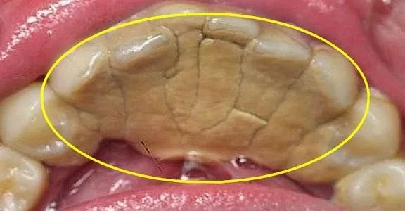 牙结石和牙结石怎么区分,牙结石颜色的鉴别