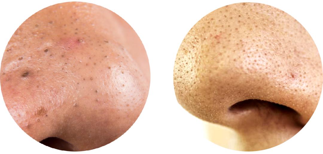 黑头毛孔粗大真的没有办法解决吗,黑头很严重毛孔粗大怎么办