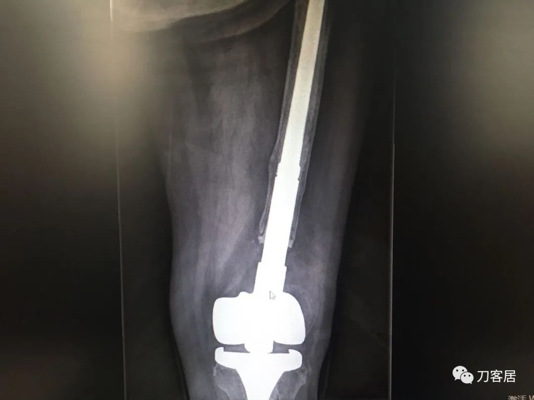 股骨胫骨骨折中医治疗方法,中药治疗股骨颈骨折