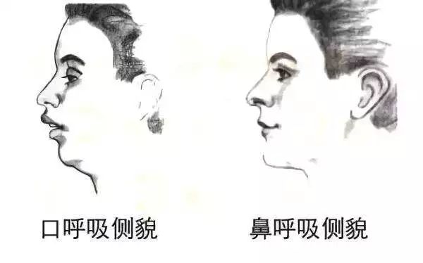 龅牙和深覆合有什么区别,龅牙矫正出现深覆合正常吗