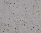 菁讲:你所不知道的横纹肌肉瘤