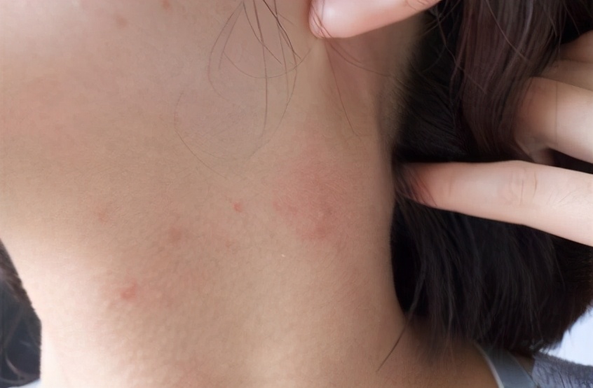 男生胸前背后长痘痘怎么治疗,胸前背后长痘痘流脓怎么解决