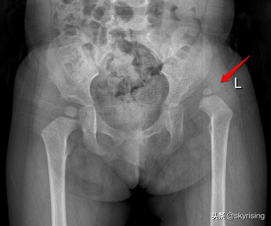先天性髋关节发育不良婴儿期症状,婴儿先天髋关节脱位图片