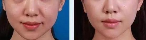 埋线面部提拉怎么样，做线雕能保持多久，不了解清楚还敢做？