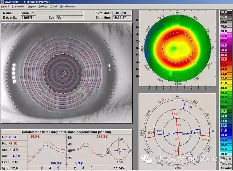 如何选择角膜塑形镜的品牌,怎么选角膜塑形镜的参数