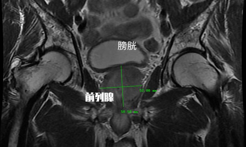 中医治疗前列腺增生什么药最有效,中医治疗前列腺增生多久能见效
