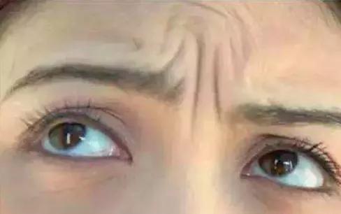 抬头纹鱼尾纹法令纹哪个更显老,抬头纹鱼尾纹法令纹颈纹一样没少