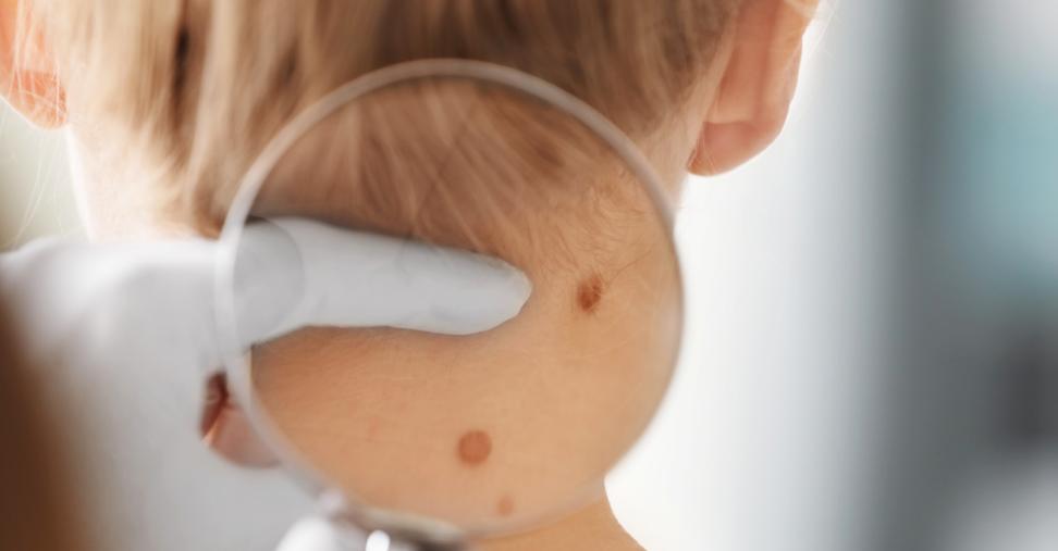 痣恶变前的3个征兆,痣的恶变会有征兆吗