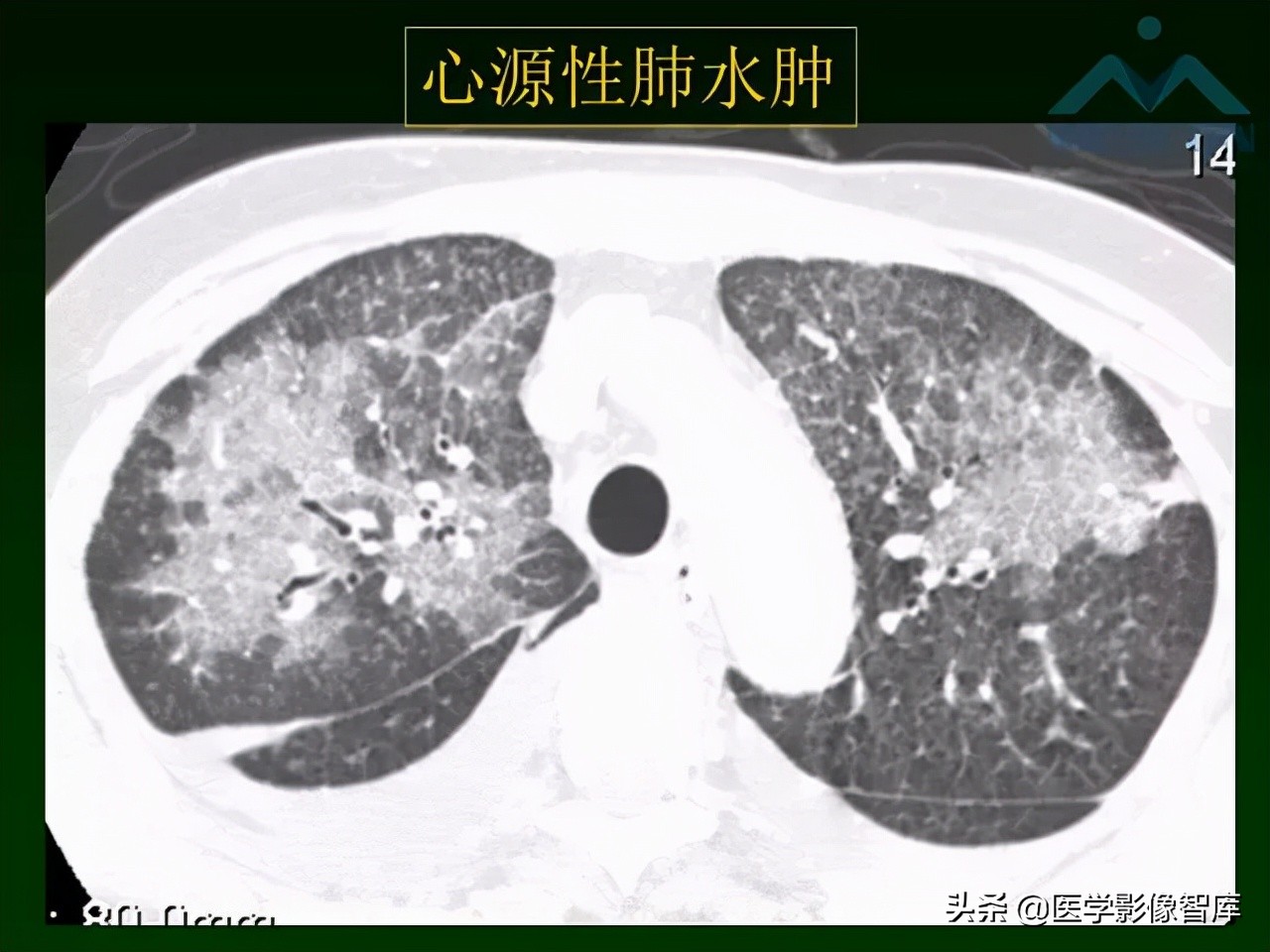 肺弥漫性网状影,两肺小叶间隔增厚可见网状模糊影