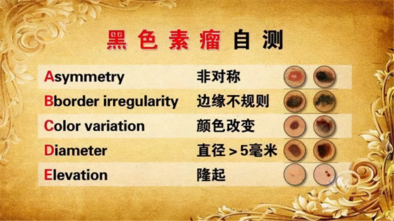 1cm大的黑肉痣是黑色素瘤吗,小孩黑色素瘤和痣的区别