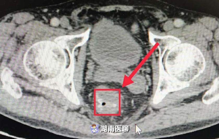 痔疮便血与大肠癌的区别,大肠癌的四个症状常被以为是痔疮