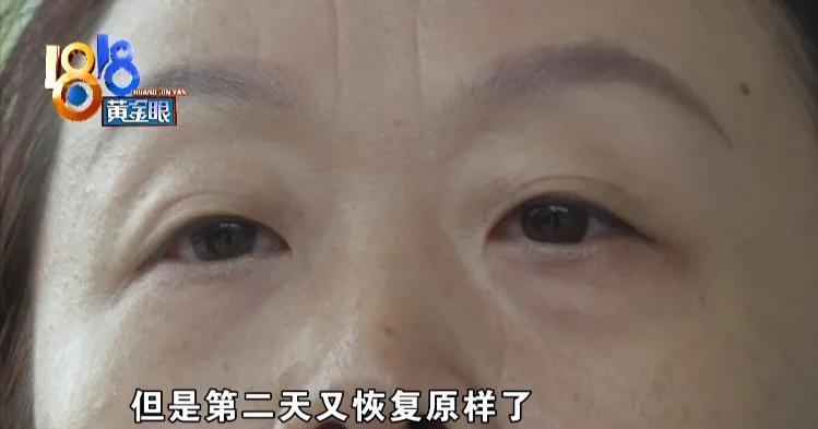 额头上有川字纹法令纹怎么治,如何去除抬头纹川字纹紧致额头